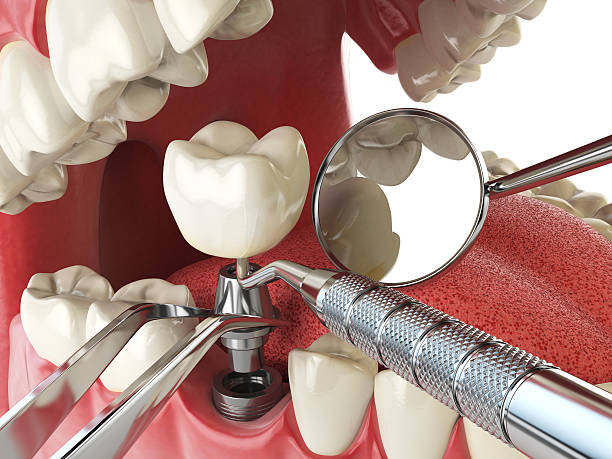 Best Emergency Tooth Extraction in Tehaleh, WA